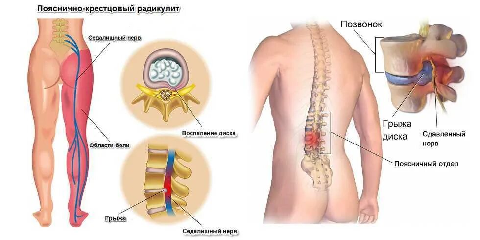 Защемление корешков в пояснице. Грыжа диска l1-l2 поясничного. Радикулопатия l1. Грыжа пояснично-крестцового отдела симптомы. Грыжа позвоночника симптомы пояснично-крестцовый.