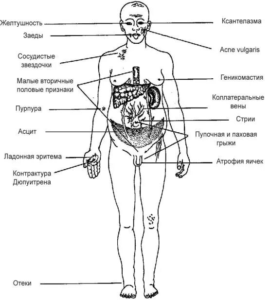 Цирроз первые признаки у женщин. Значимый клинический признак цирроза печени. Основные клинические признаки цирроза печени. Цирроз печени симптомы внешним признакам. Схема основных проявлений цирроза печени.