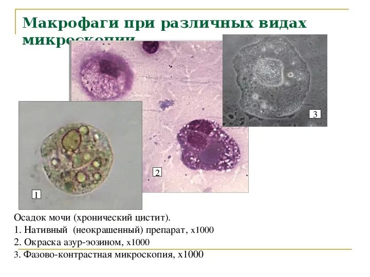 Макрофаги препарат. Простатический сок микроскопия. Секрет простаты микроскопия атлас. Макрофаги в моче под микроскопом. Макрофаги в осадке мочи.