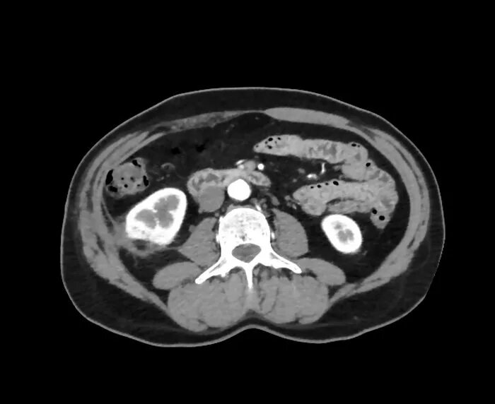 Гиперваскулярное образование почки на кт. Гиперденсные образования почек на кт. Гиперваскулярная опухоль почки. Гиперваскулярное образование печени
