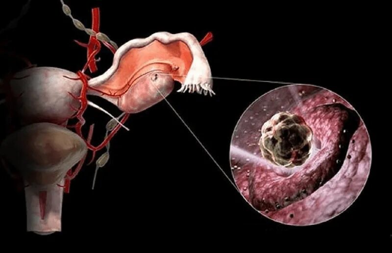 Маточная труба поликистоз. Овуляция. Лопнула овуляция