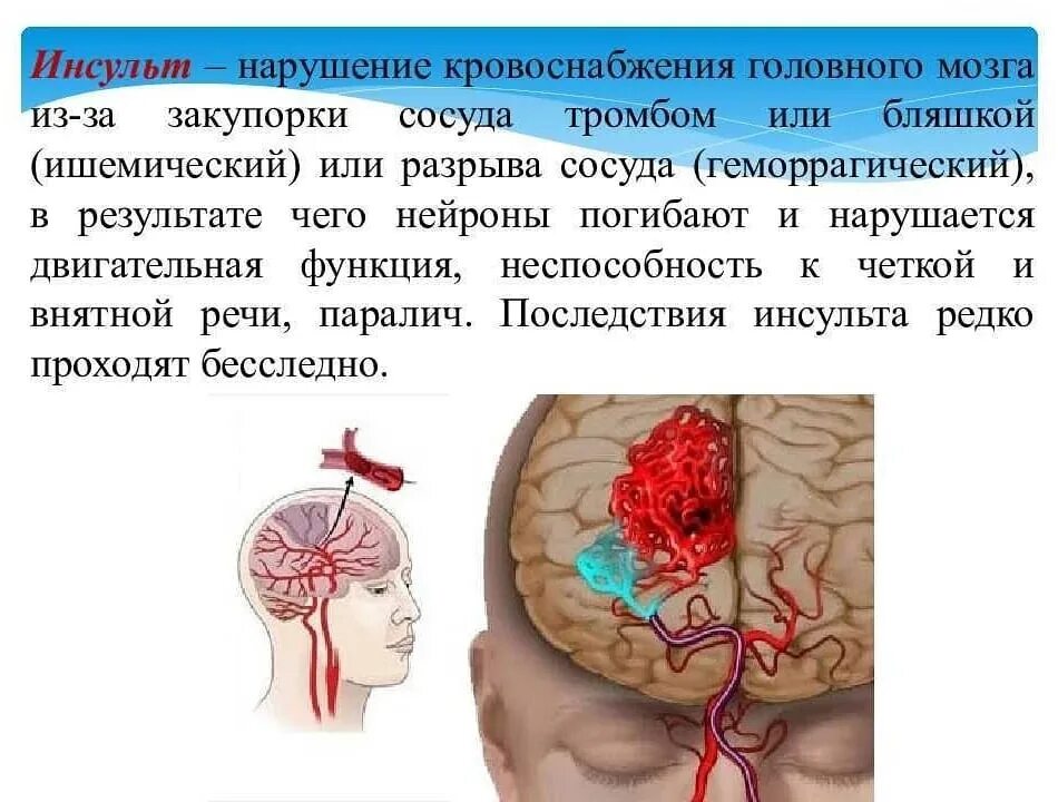 Поражение головного мозга последствия. Инсульт сосудов головного мозга. Артерии мозга при инсульте.