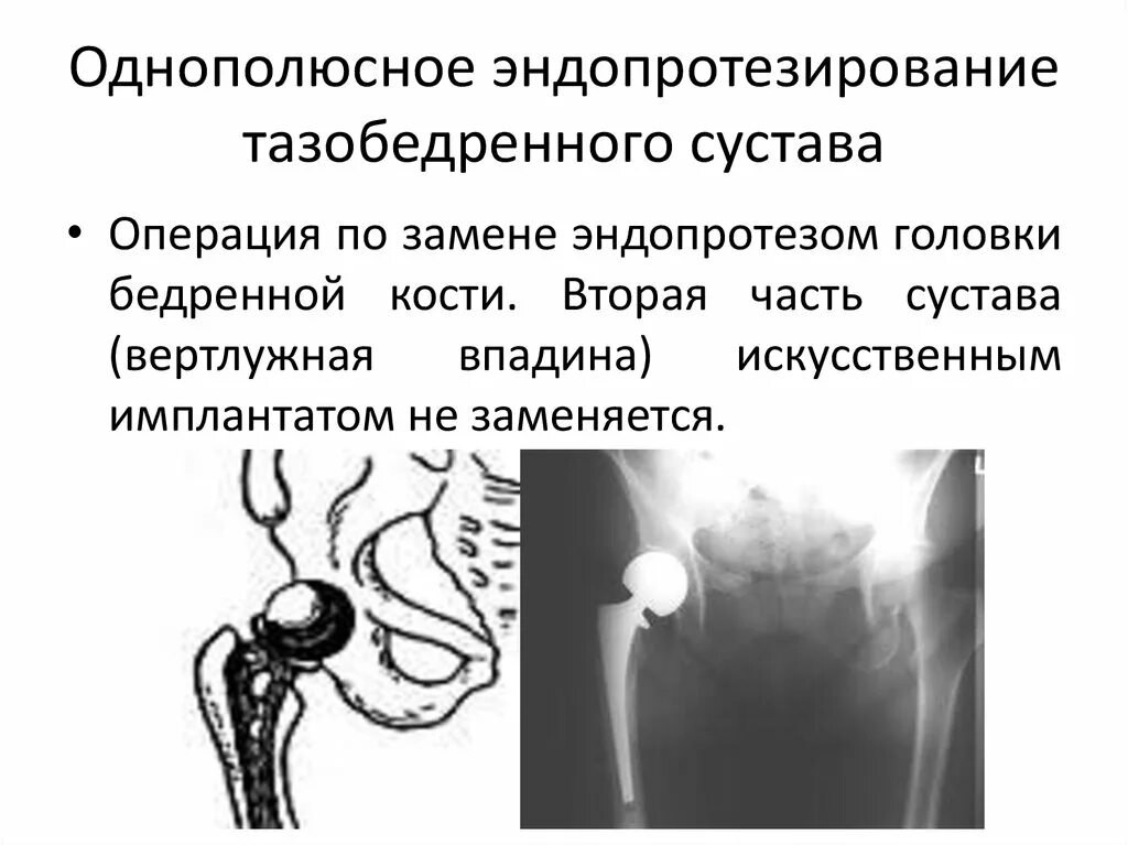 Отзывы после эндопротезирования. Однополюсное эндопротезирование тазобедренного сустава рентген. Однополюсный протез тазобедренного сустава. Монополярный эндопротез. Вертлужная впадина эндопротез.