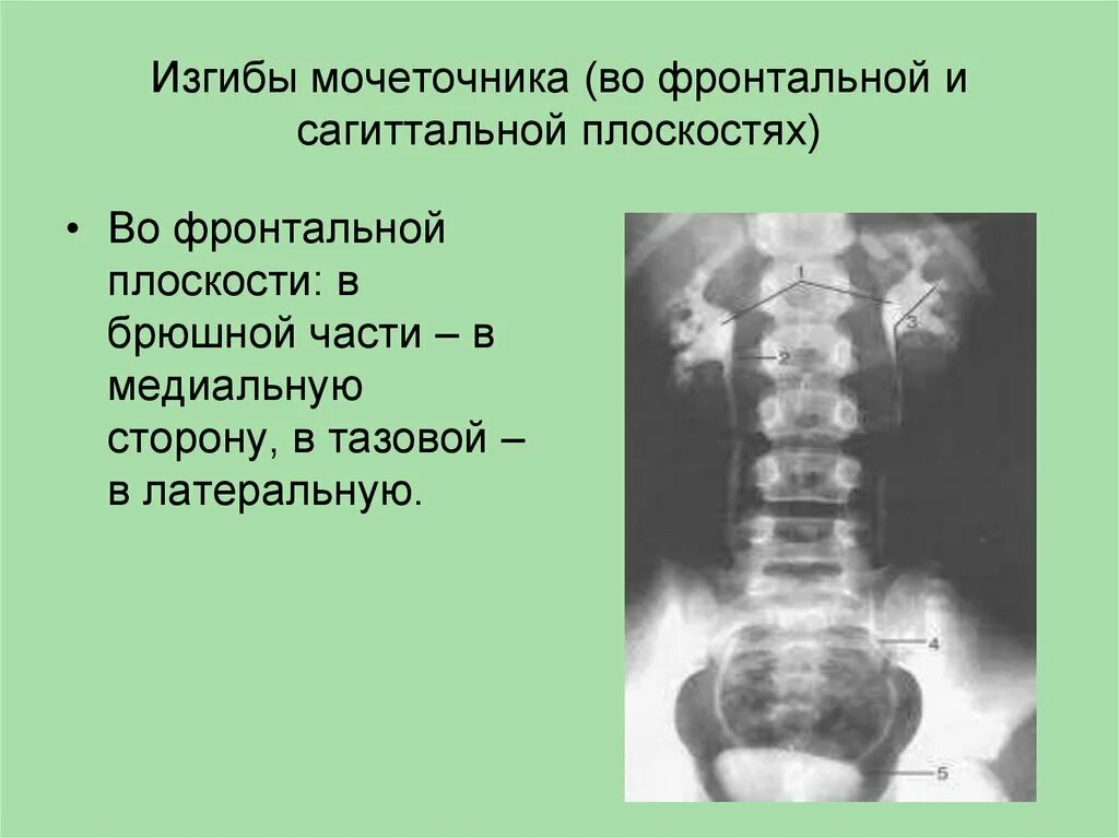 Изгибы мочеточника