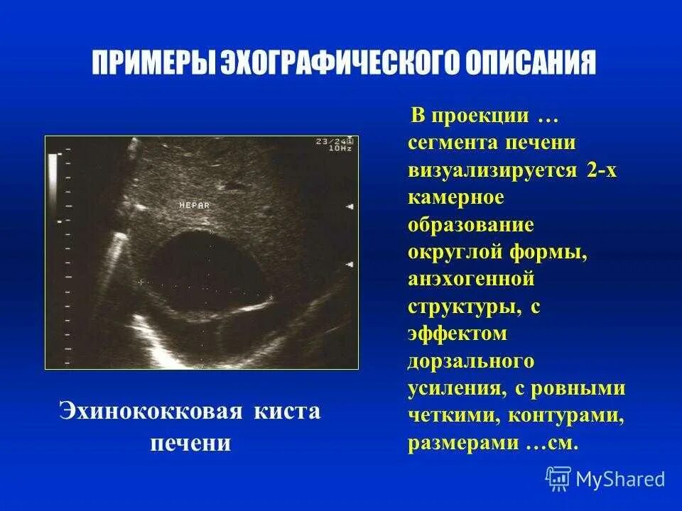 Образование округлое в яичнике. Анэхогенная структура УЗИ. Анэхогенное аваскулярное образование. Киста в печени анэхогенное образование. Множественные анэхогенные образования.