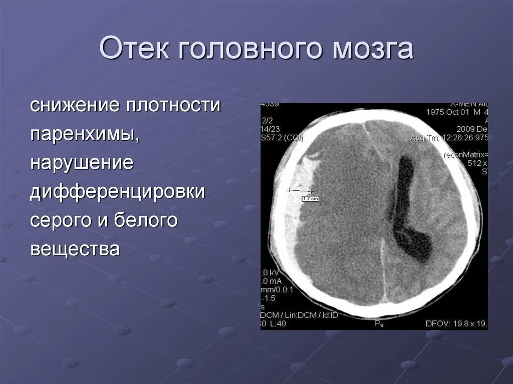 Кт острой субдуральной гематомы. Острая субдуральная гематома кт. Кт при отеке головного мозга. Признаки отека мозга при кт головного.