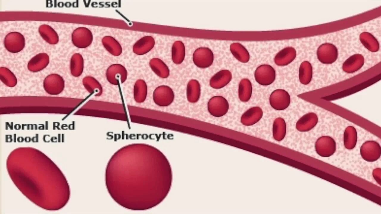 Селезенка и эритроциты. Анемия Минковского-Шоффара. Микросфероцитоз Минковского-Шоффара. Наследственный микросфероцитоз Минковского Шоффара. Болезнь Минковского Шоффара патогенез.
