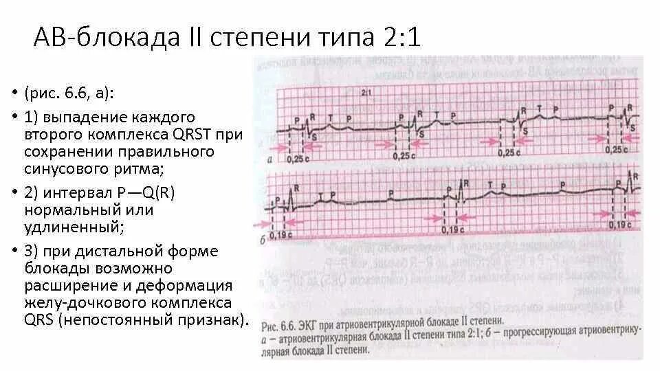 Блокада на первом. АВ блокада 2 степени типа Мобитц 2. АВ блокада 2 степени Мобитц 3 на ЭКГ. Атриовентрикулярная блокада 1 ЭКГ. ЭКГ атриовентрикулярная блокада II степени Мобитц 2.