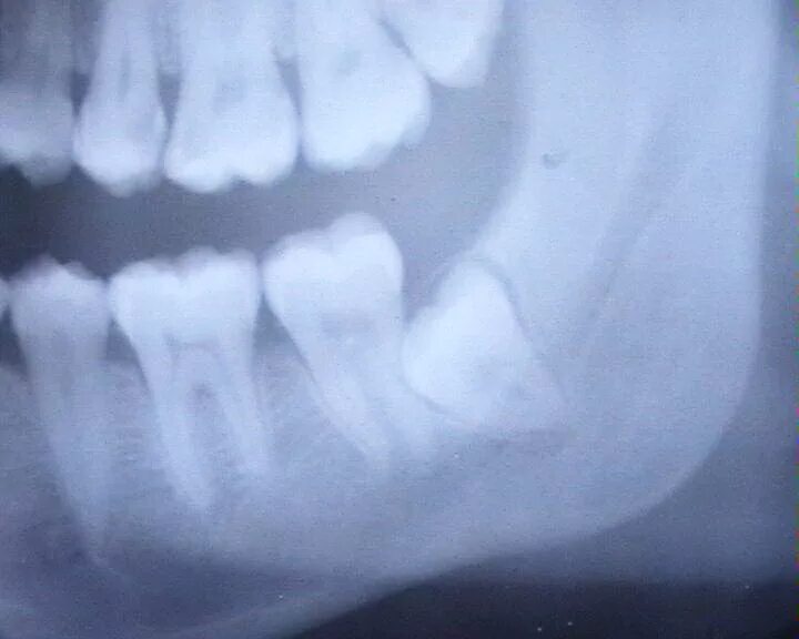 Лечение зуба 8. Перикоронарит нижней челюсти. Перикоронит зуба мудрости.