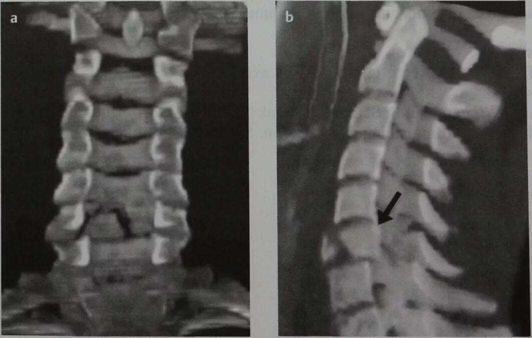 Компрессионный перелом 6 шейного позвонка рентген. Сгибательный перелом позвонка рентген. Перелом шейных позвонков рентген. Сгибательный перелом позвоночника рентген.