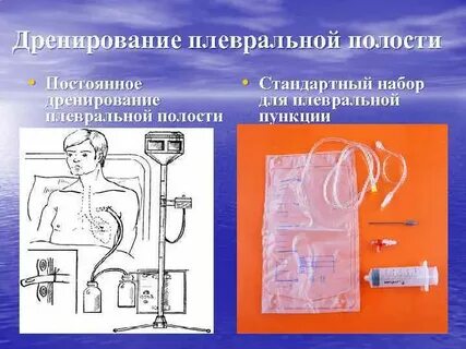 Набор плевральной полости