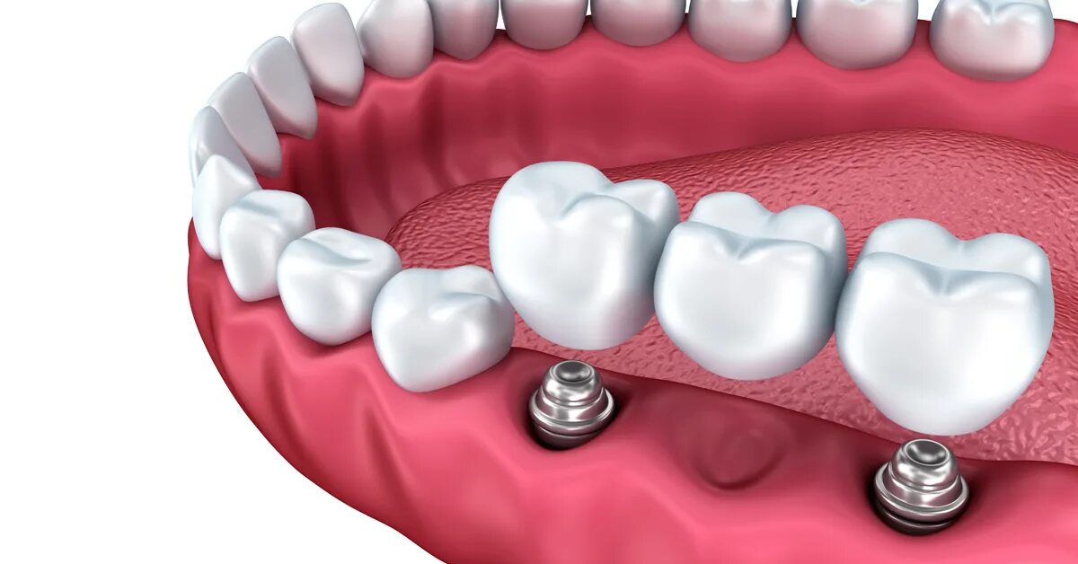 Мостовидные несъемные зубные. Несъемный мостовидный протез. Мостовидные несъемные зубные протезы. Мостовидный протез на 6 имплантах.