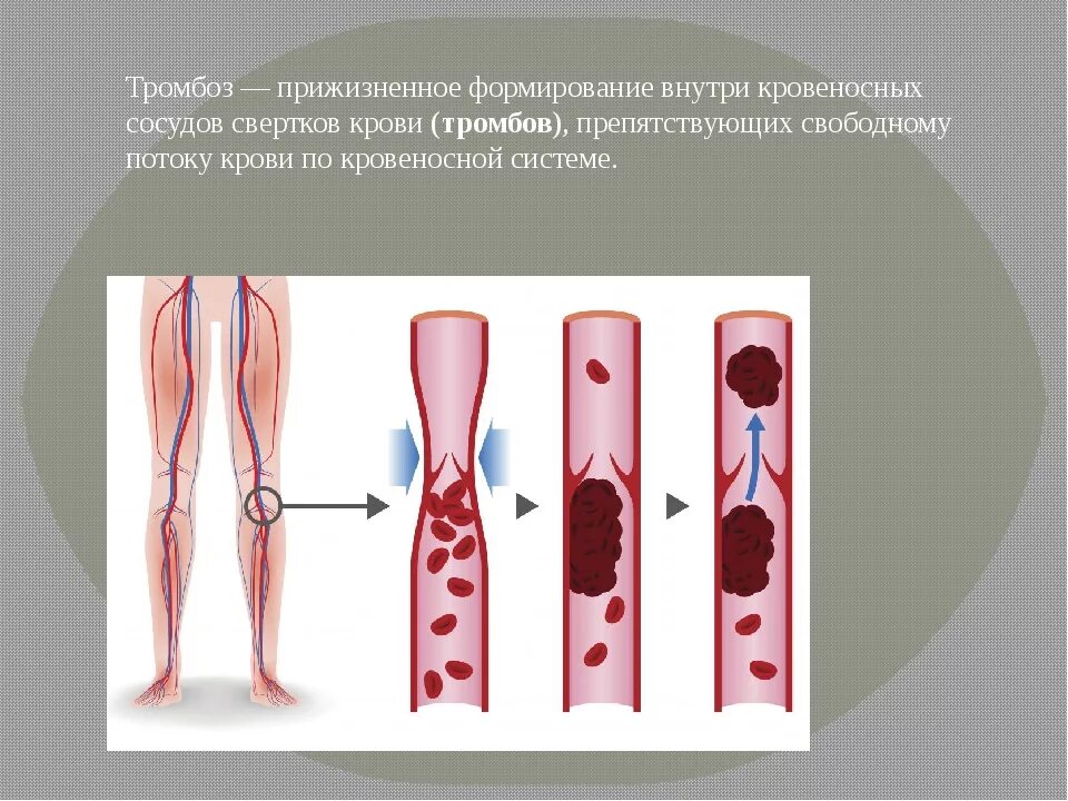 Тромбофлебит артерий