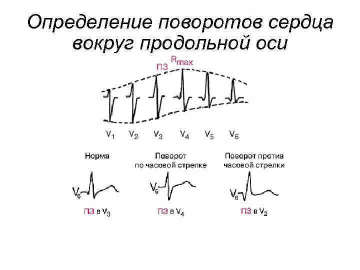 Поворот сердца правым желудочком вперед что это. Определение поворотов сердца вокруг продольной оси. Определение поворотов сердца вокруг продольной оси на ЭКГ. ЭКГ поворот сердца продольной оси. Повороты сердца на ЭКГ вокруг продольной оси.