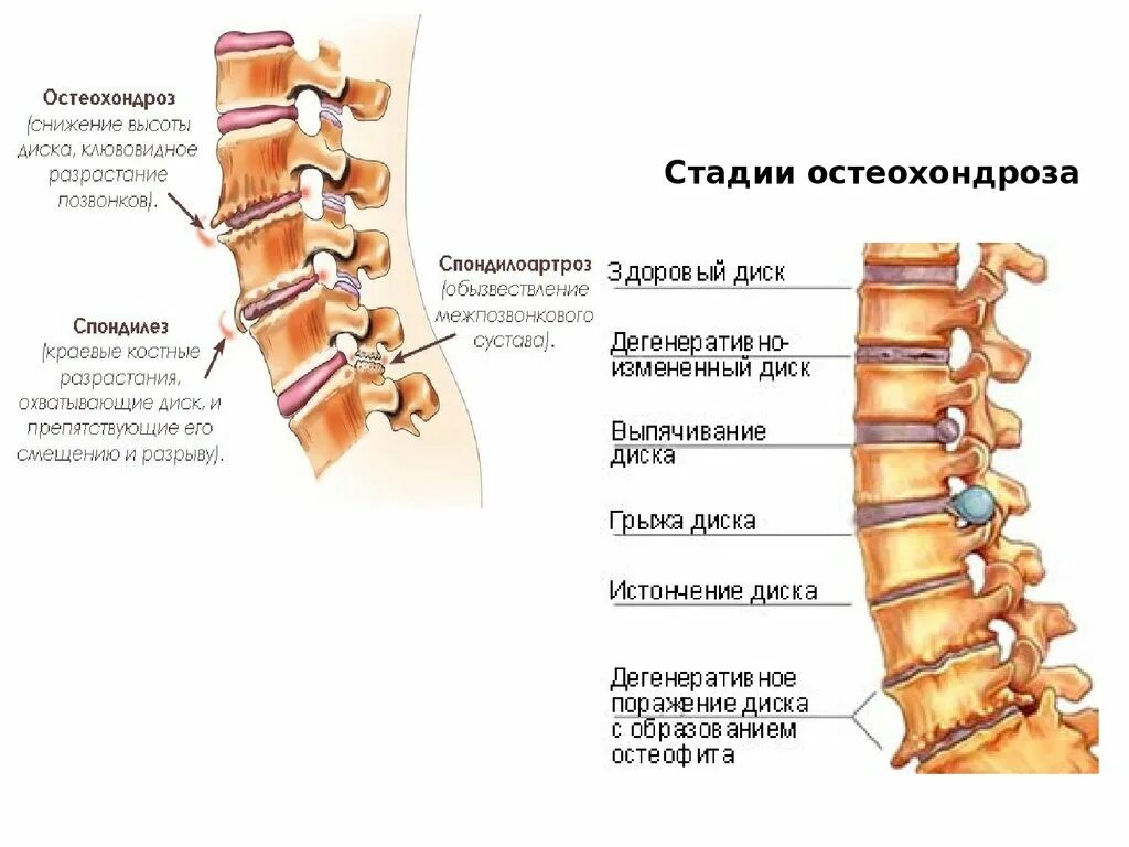 Остеохондроз поясничного отдела l5 s1. Спондилоартроз на уровне th12-l2 сегментов. Спондилоартроз л4 s1. Спондилоартроз с4 th1. Остеофиты l5, s1 тел позвонков.