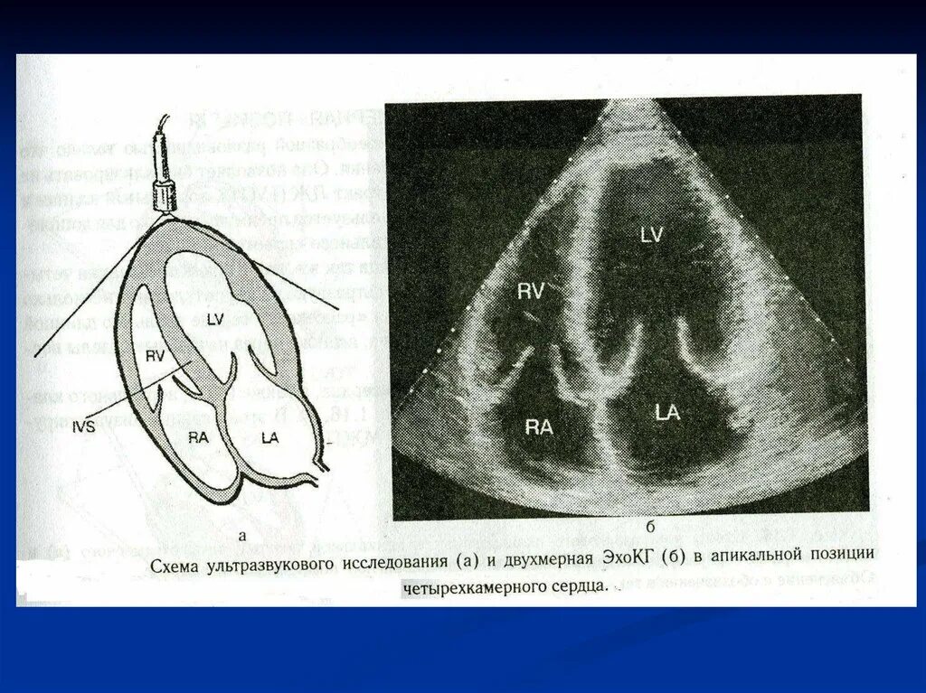 Эхо кс цена. Апикальная позиция ЭХОКГ. ЭХОКГ В 4 камерной позиции. Апикальная позиция Эхо кг. Пятикамерная позиция ЭХОКГ.