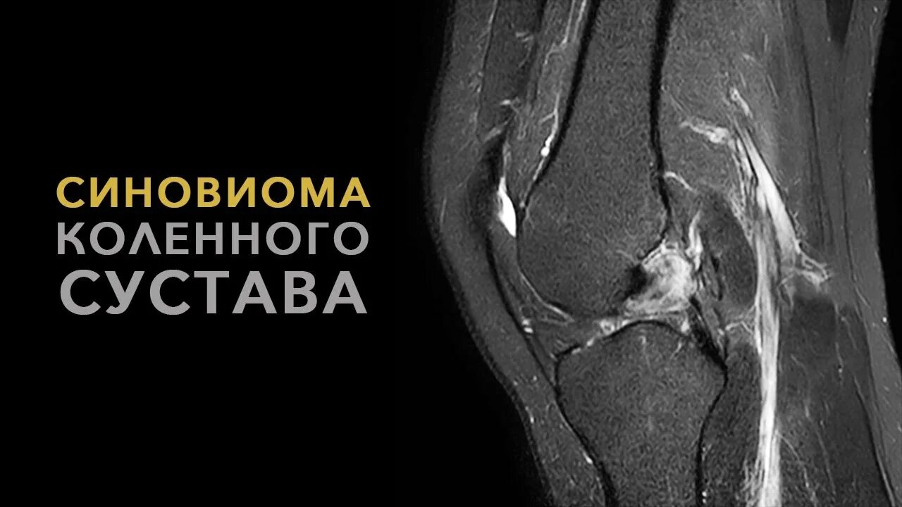 Синовиомы