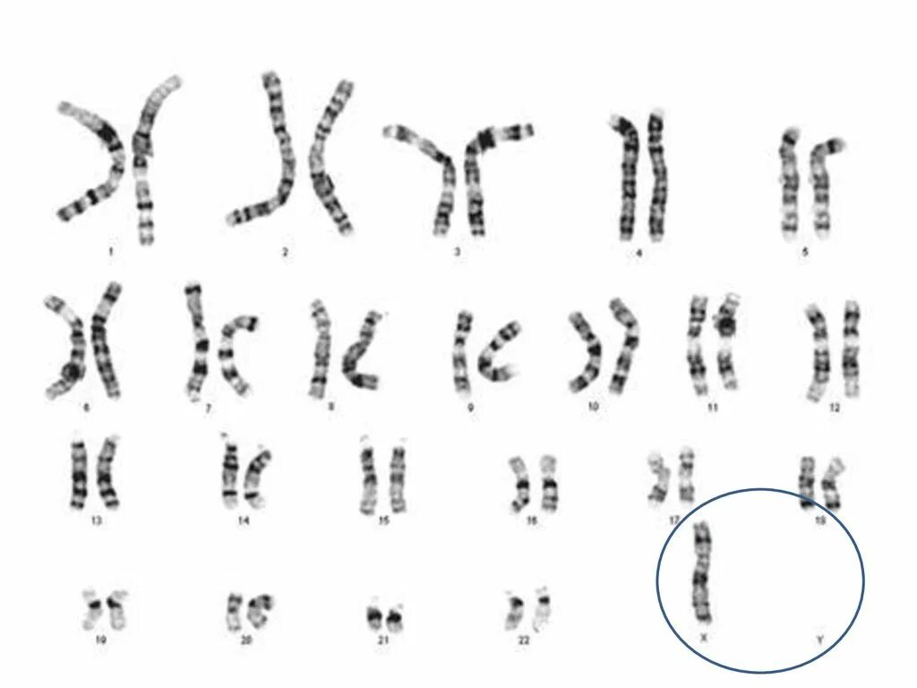 Удвоение хромосом какая мутация. Синдром Шерешевского Тернера кариотип. Кариотип Шерешевского-Тернера кариотип. Кариотип при синдроме Шерешевского-Тернера.