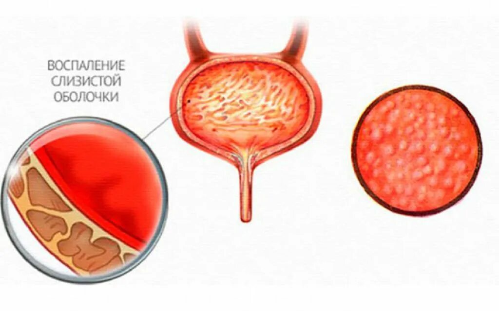 Заболевание цистит болезнь. Хронический интерстициальный цистит. Геморрагический цистит. Цистит воспаление мочевого пузыря.