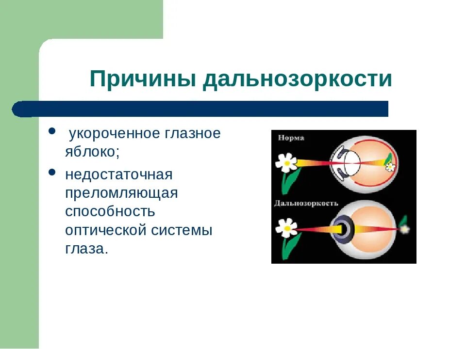 Причины возникновения дальнозоркости