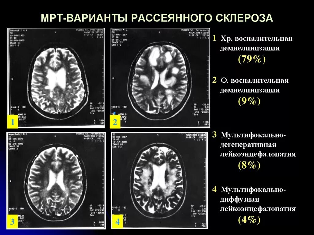 Склероз мозга. Мрт очаги поражения рассеянный склероз. Пальцы Доусона при рассеянном склерозе на мрт. Мрт рассеянный склероз планинг. Картина рассеянного склероза на мрт.