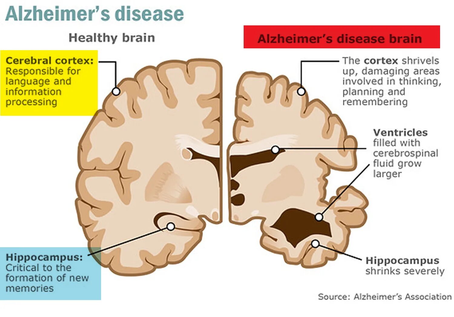 Brain disorders. Болезнь Альцгеймера. Болезнь Альцгеймера презентация. Головной мозг при болезни Альцгеймера.
