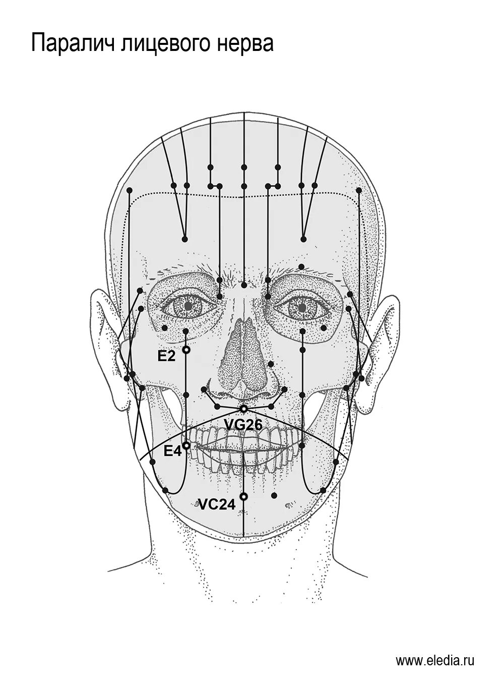 Иглоукалывание лицевой нерв. Точки акупунктуры при неврите лицевого нерва. Точки акупунктуры при лицевом неврите. Эледиа акупунктура атлас. Акупунктурные точки при неврите лицевого нерва.