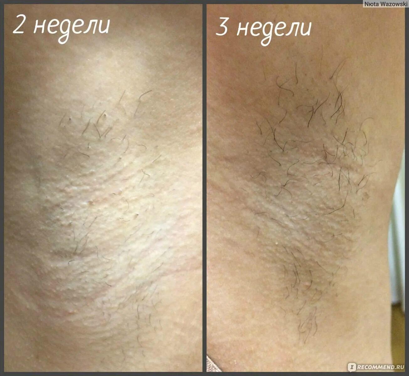 Лазерная эпиляция волосы выпадают через. Лазерная эпиляция.