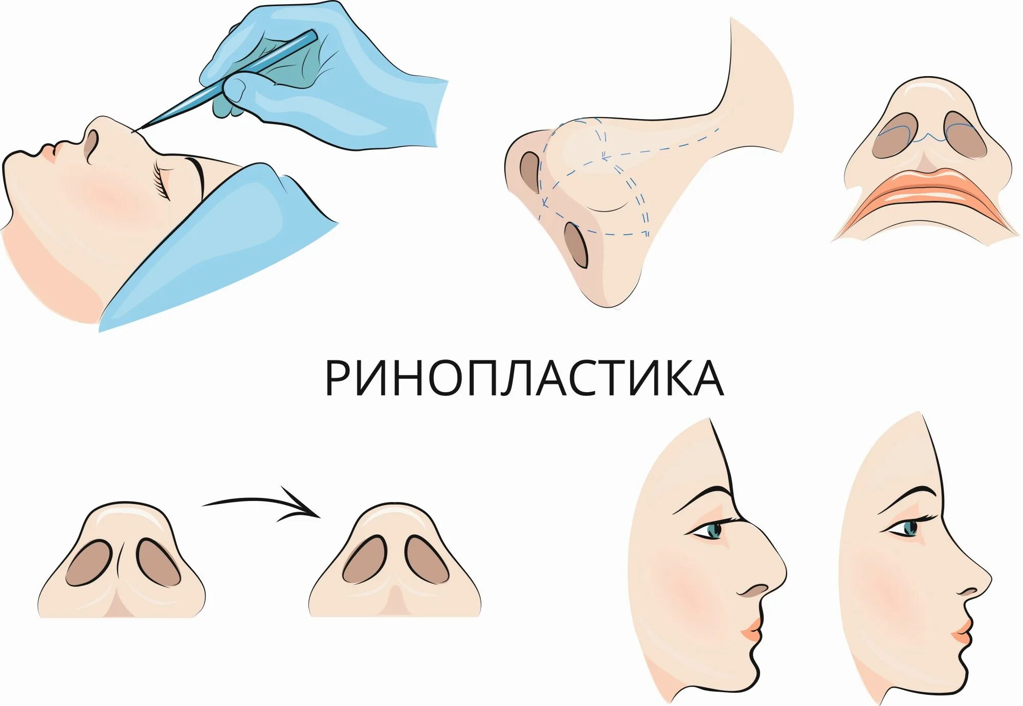 Пластика носа. Ринопластика носа. Ринопластика носа схема.