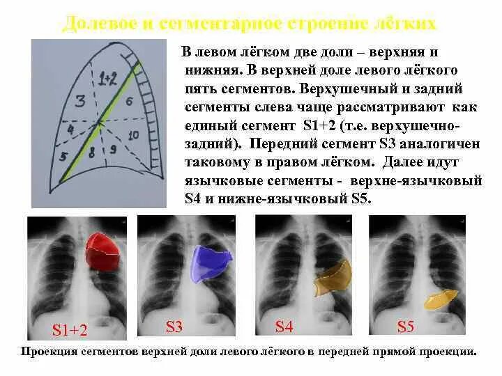 S 1 легкого. Ателектаз нижней доли левого легкого рентген. Сегменты легкого рентген схема. Сегмент s3 левого легкого.