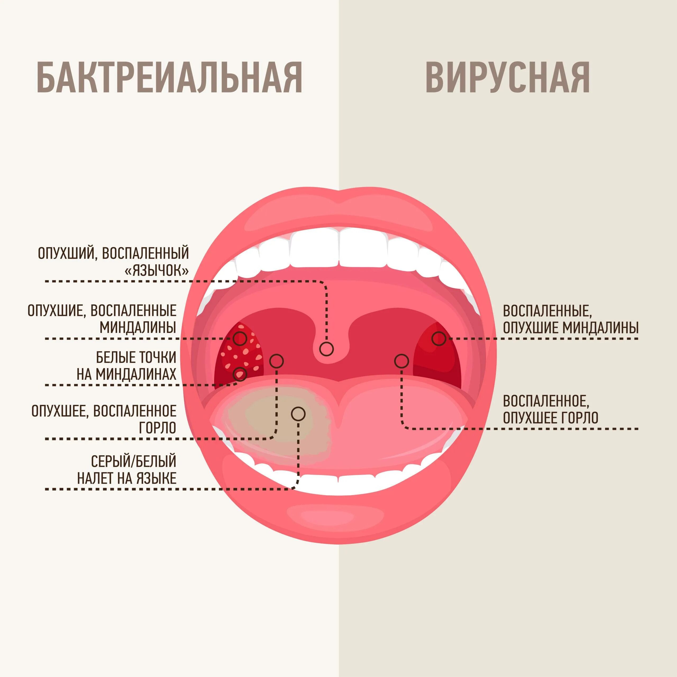 Зев красный. Вирусная ангина герпетическая инфекция.