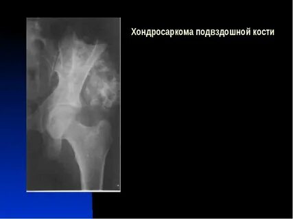 Хондросаркома
