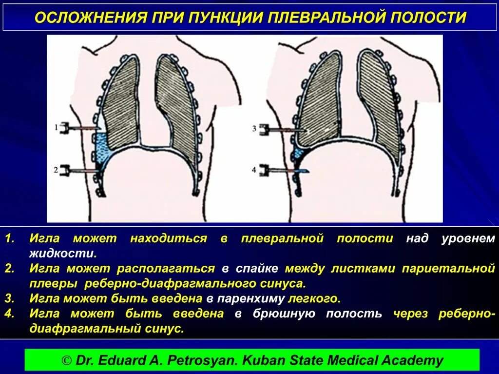 Плевральная пункция гидроторакс. Пункция реберно диафрагмального синуса. При гидротораксе пункция синуса. Осложнения возникающие при пункции плевральной полости. Плевральные осложнения