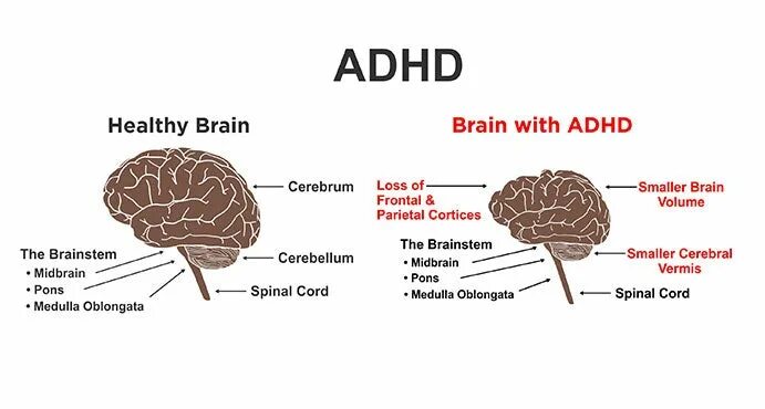 Brain vs brain. ADHD Brain. ADHD Brain structure. Brain with ADHD. ADHD Brain Cortex.