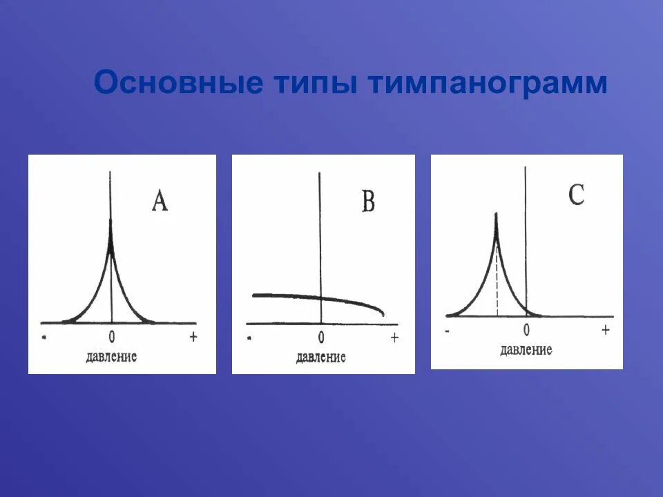 импедансометрия и тимпанограмма. тимпанометрия интерпретация результатов. тимпанометрия при тугоухости. тимпанометрия тип а с обеих сторон что это. отосклероз тимпанометрия.