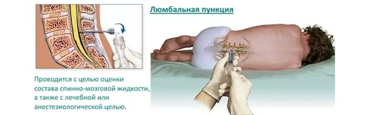 Ощущение после пункции. Люмбальная пункция смж. люмбальная спинномозговая пункция топографическая анатомия. техника пункции ликвора. пункция спинного мозга проводится.