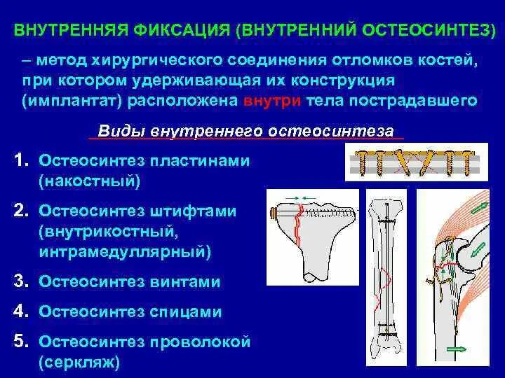 Экстрамедуллярный остеосинтез. Погружной накостный (экстрамедуллярный) остеосинтез. Экстрамедуллярный остеосинтез голени. Остеосинтез классификация травматология. Осложнения остеосинтеза