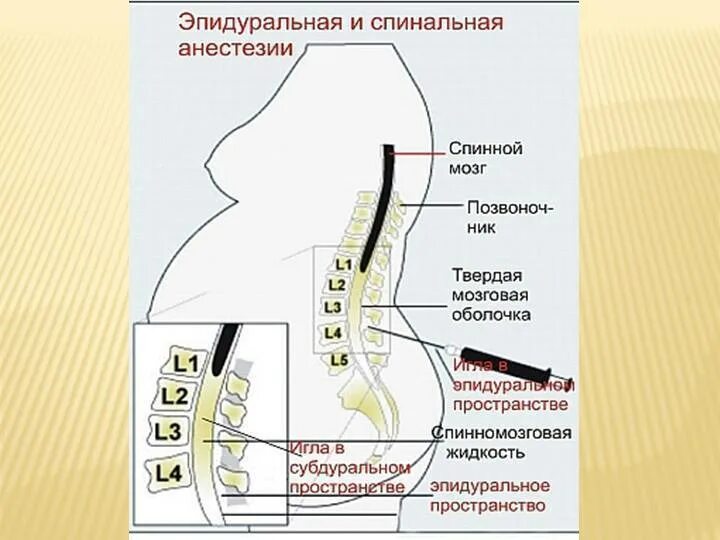 Эпидуральная и спинальная анестезия разница. Субдуральная и эпидуральная анестезия. Комбинированная спинально-эпидуральная анестезия. Эпидуральная анестезия при родах.