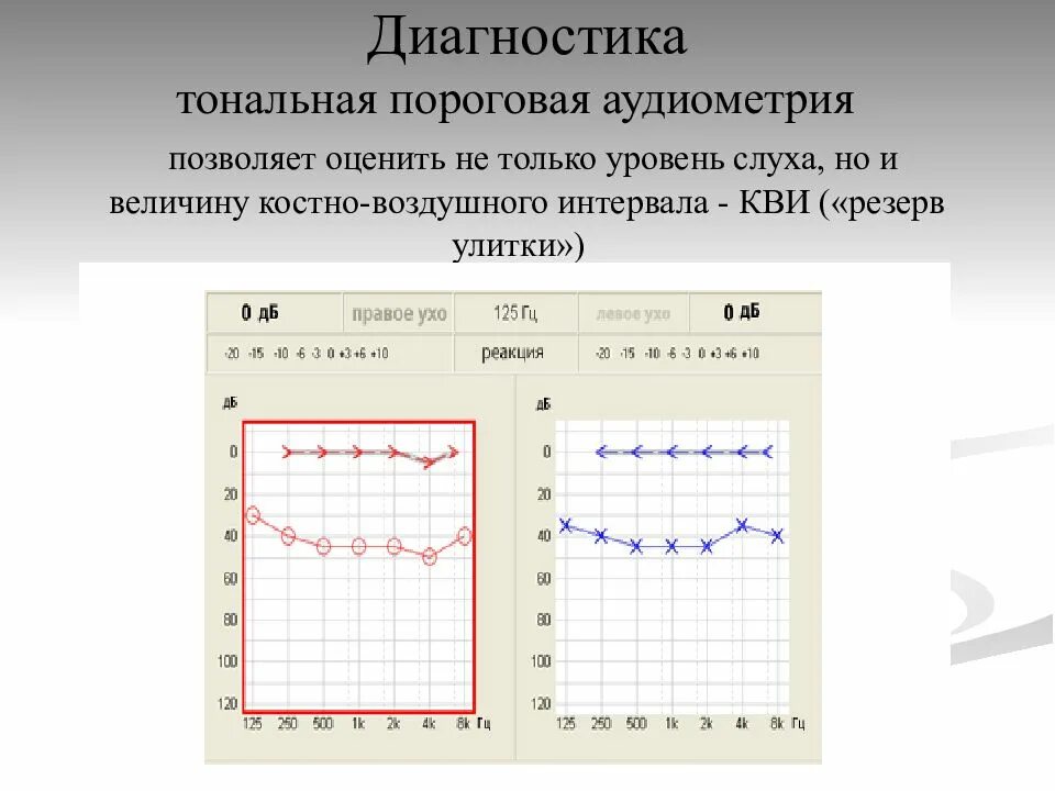 Аудиограмма норма. Кондуктивная тугоухость аудиограмма. Аудиограмма слуха норма отклонения. Тональная пороговая аудиометрия при тугоухости. Тональная пороговая аудиограмма норма.