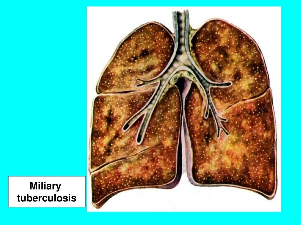 Туберкулез tuberculosis. Туберкулез милиарный каверны. Милиарный туберкулез Орыщак. Милиарный туберкулез легких КРС. Кавернозный туберкулез фтизиатрия.