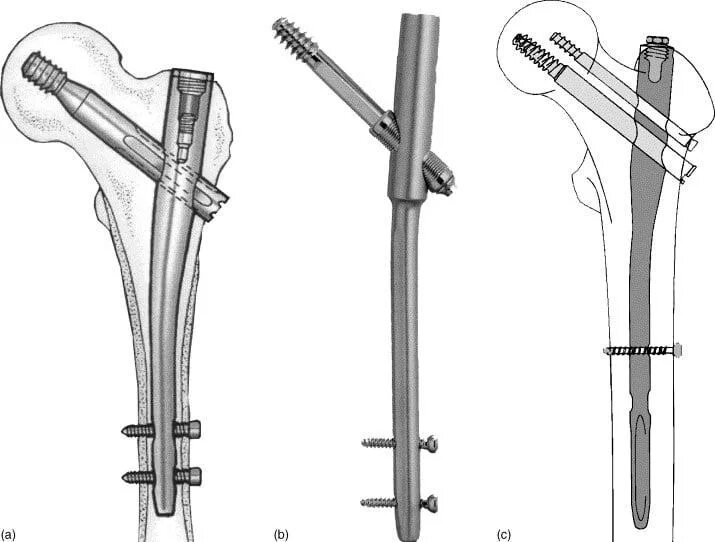 Интрамедуллярный остеосинтез шейки бедра гамма. Интрамедуллярный блокируемый остеосинтез. Остеосинтез перелома бедренной кости. Блокируемый интрамедуллярный остеосинтез биос.