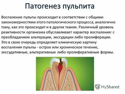 Пульпит классификация