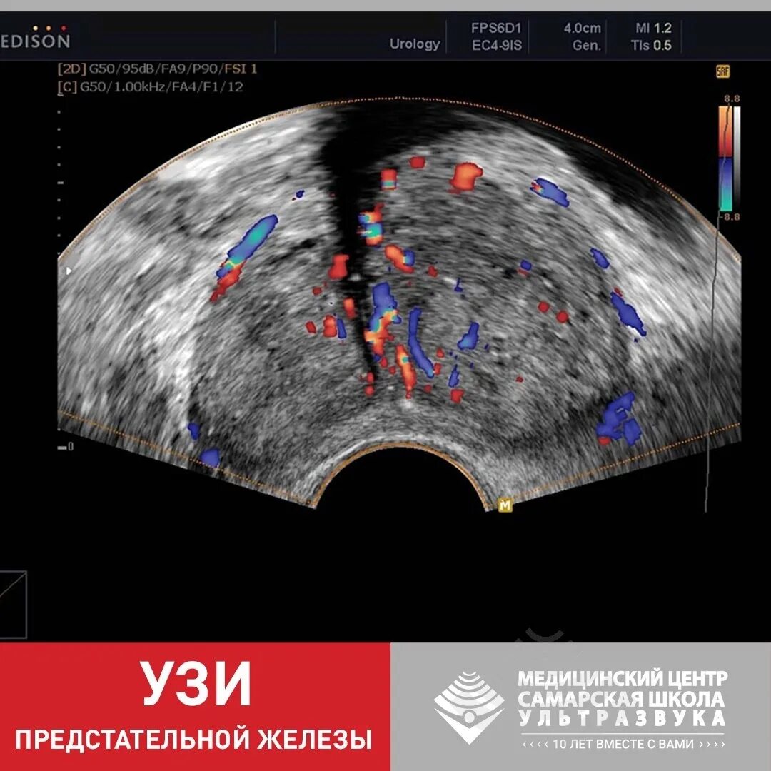 Полостное УЗИ предстательной железы. Аденома предстательной железы на УЗИ. Трансабдоминальное УЗИ предстательной железы. Трузи предстательной железы как делают