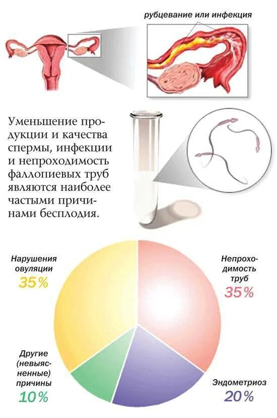 Почему не может забеременеть ?. Не беременею причины. Причины не забеременеть. Причины почему не удается забеременеть.