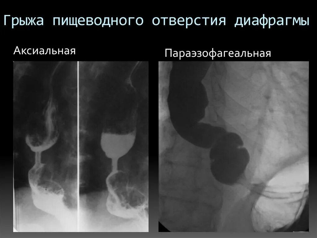 Параэзофагеальная диафрагмальная грыжа. Параэзофагеальные грыжи пищеводного отверстия диафрагмы рентген. Скользящая ГПОД рентген. Грыжа пищеводного отверстия причины