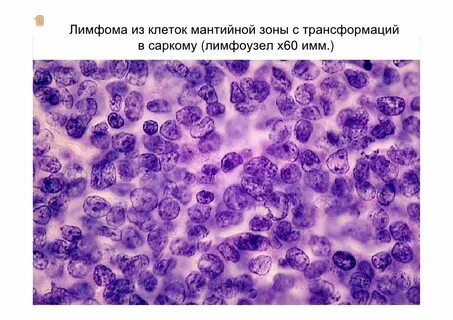 Экстранодальная лимфома маргинальной зоны
