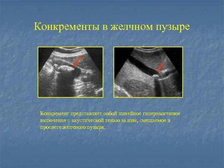 Гиперэхогенные включения в желчном пузыре. Конкременты желчного пузыря 24мм 20мм 11мм. УЗИ картина водянки желчного пузыря. Гиперэхогенный желчный пузырь УЗИ. Формирование конкрементов в желчном пузыре- это.