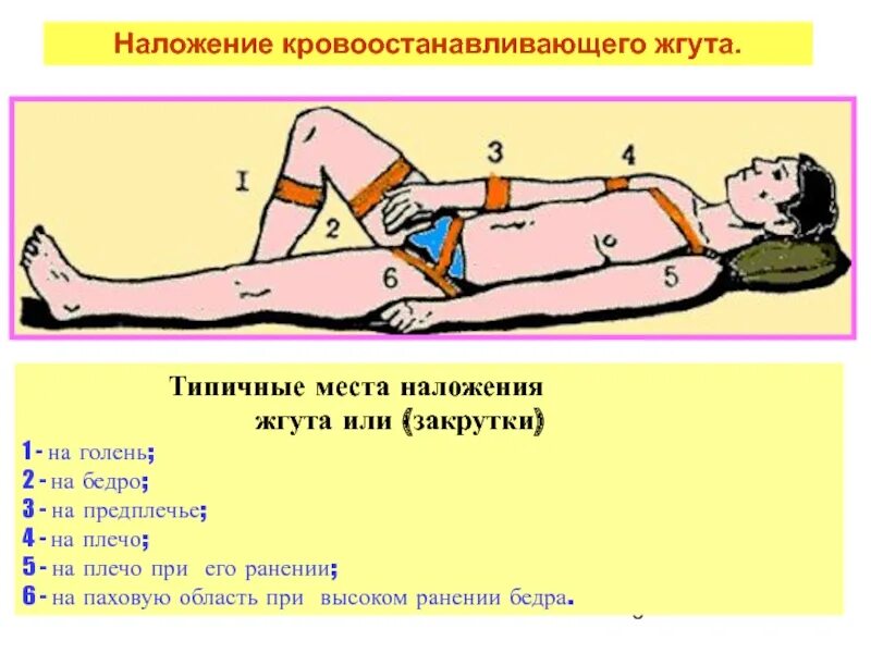 Техника наложения кровоостанавливающего жгута жгута. Наложение кровоостанавливающего жгута на предплечье. Место наложения жгута на предплечье. Места наложения жгута на бедро. Как правильно наложить артериальный жгут