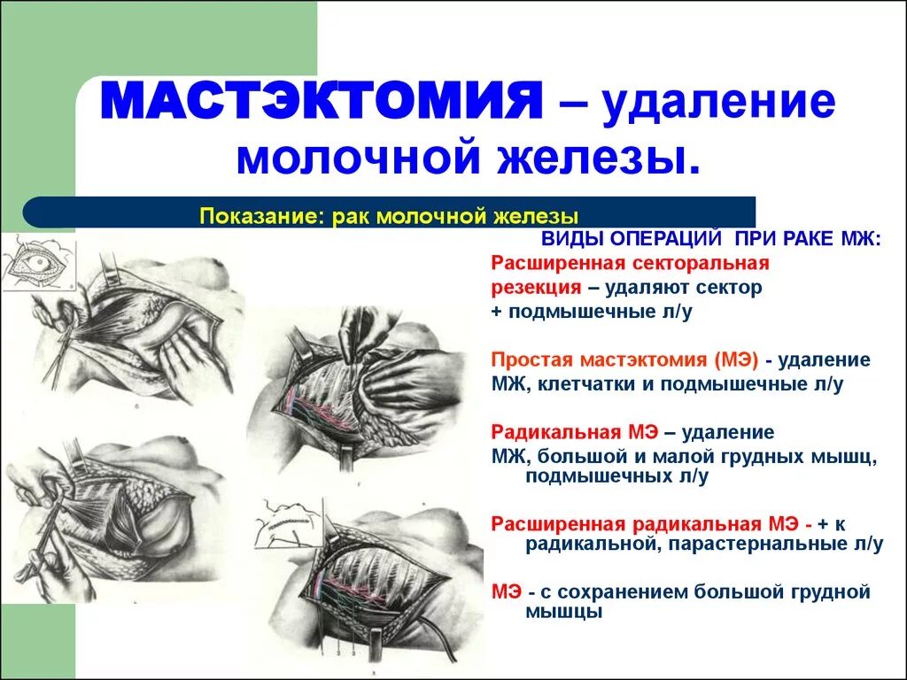 После операции молочной железы и лимфоузлов. Операция мастэктомия молочной железы. Операции на молочной железе топографическая анатомия. Операции при опухоли молочной железы. Радикальная секторальная резекция.