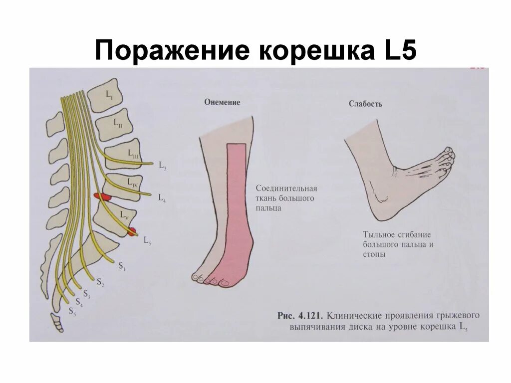 Корешковое поражение. Поражение корешка л5. Поражение корешка l5. Синдром компрессии корешка l5. Синдром компрессии s1 корешка справа.